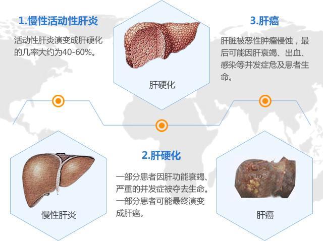 肝炎最新進展與研究概述